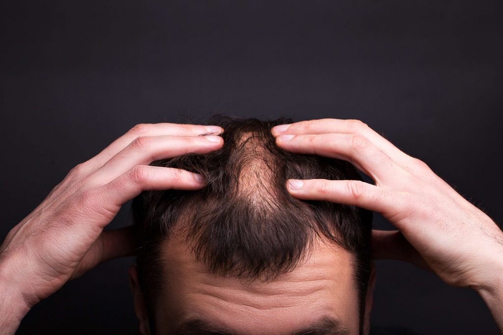 long-term effects of steroids - baldness