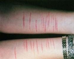 teen cutting and self harm